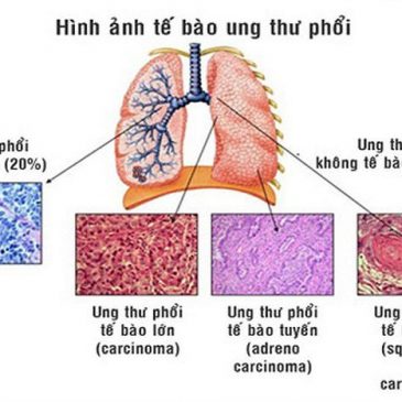 Phân loại ung thư phổi nguyên phát