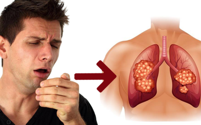  triệu chứng ban đầu ung thư phổi