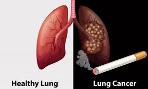 hút thuốc lá và ung thư phổi