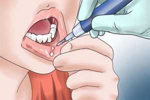 Loét miệng có thể tiến triển thành ung thư