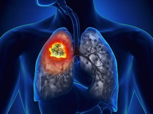 Đau lưng có thể là dấu hiệu ung thư phổi