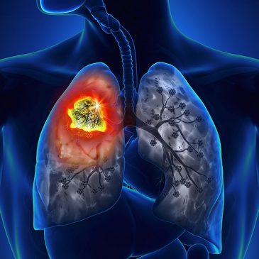 Bệnh ung thư phổi có lây không?
