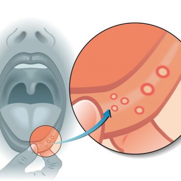 Sự khác biệt giữa loét miệng và ung thư miệng là gì?