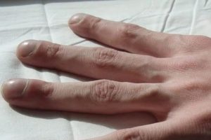 Đoán tình hình sức khỏe nhờ dấu hiệu ở móng tay